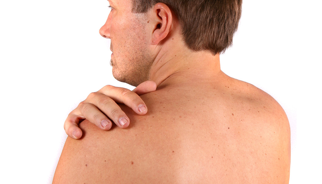 Man with his hand on bare shoulder showing moles