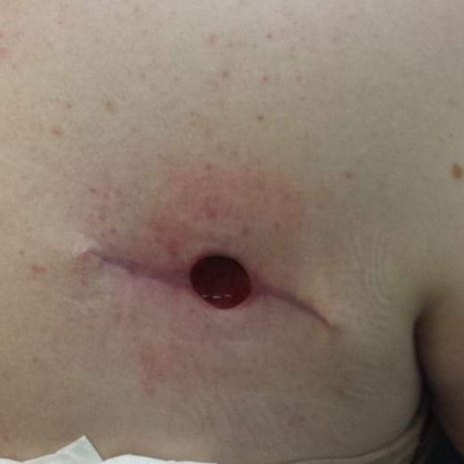 Cancer Council SA Sharons melanoma post surgery