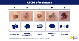 ABCDE of melanoma