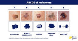 Cancer Council SA. SunSmart ABCDE of melanoma