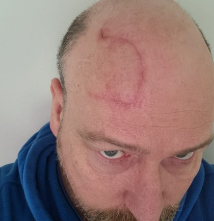Cancer Council SA Darren skin cancer scar