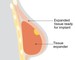 Image of expanding a tissue expander