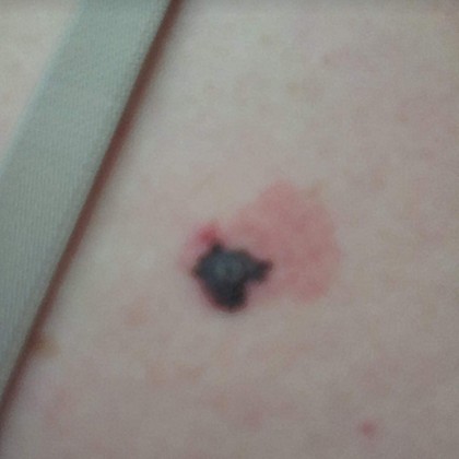 Cancer Council SA Sharons melanoma pre surgery