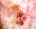 Image of melanoma skin spot