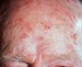 Image of older mans head with solar keratoses skin spots