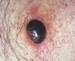 Image of nodular melanoma skin spot