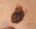 Image of seborrheic keratoses skin spot