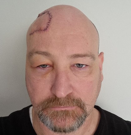 Cancer Council SA Darren skin cancer scar
