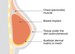Image of subpectoral implant reconstruction
