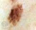 Image of dysplastic naevus skin spot