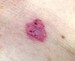 Image of a Basal Cell Carcinoma skin spot. 