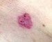 Image of a Basal Cell Carcinoma skin spot. 