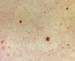 Image of mole skin spots
