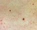 Image of mole skin spots